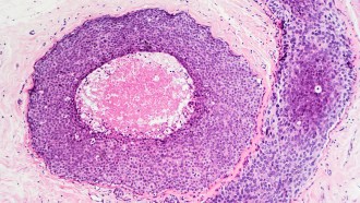 A microscope image of ductal carcinoma in situ